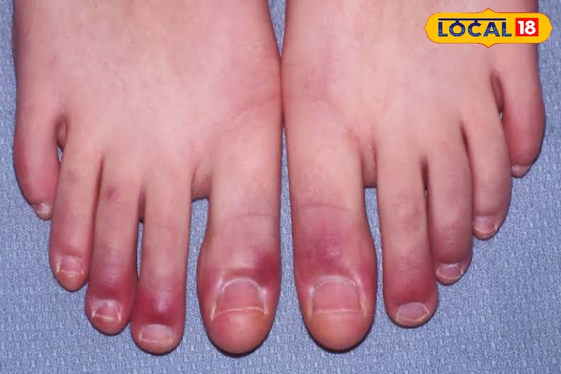 গুরুতর অবস্থায় তা গ্যাংগ্রিন বা ক্ষতে পরিণত হয়।