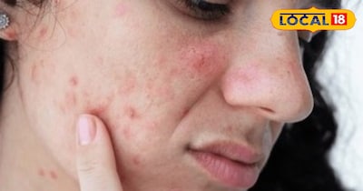 रूखी त्वचा 