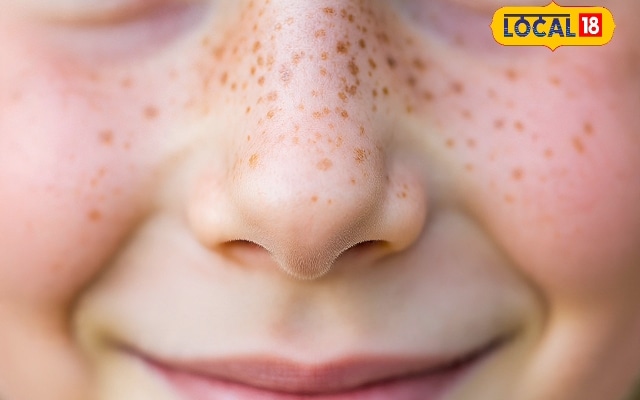 Tips and Tricks : नाक के दाने और कील से तुरंत मिलेगा छुटकारा, घर पर ही अपनाएं ये ट्रिक, 100% घरेलू नुस्खा