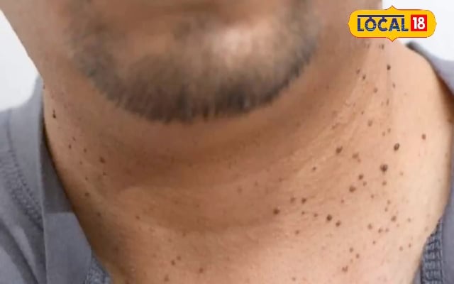 Tips and Tricks: शरीर पर मस्सों से हैं परेशान? मुक्ति पाने के ये हैं घरेलू नुस्खे, खूबसूरत दिखेगी आपकी त्वचा