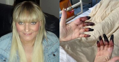 किडनी स्टोन से सेप्टिक शॉक, महिला के हाथ-पैर की उंगलियां काटनी पड़ीं: भयावह अनुभव.