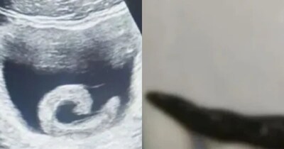 Man Inserts Live Leech into Urethra for 'Miraculous' Cure, Ends Up in ER