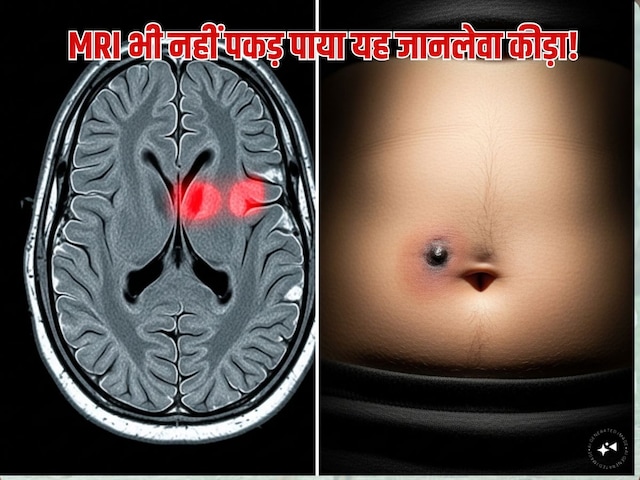 Worm started eating the brain of a 29 year old man, even MRI could not detect it, doctor