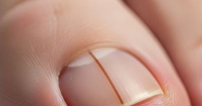 नाखून पर काली लकीर कैंसर के संकेत!