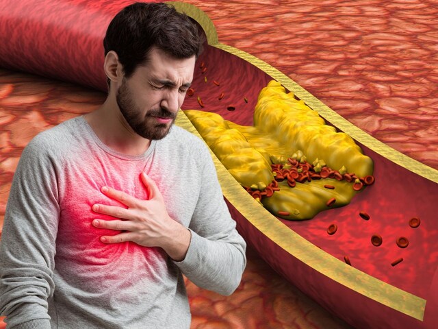 কোলেস্টেরল রোগীদের হার্ট অ্যাটাকের ঝুঁকি কতটা? সত্যটা জেনে নিন ডাক্তারের কাছ থেকে