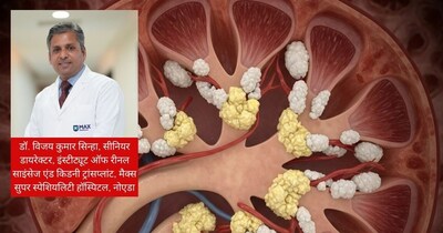 क्रिएटिनिन 4.77 mg/dL: क्या डायलिसिस जरूरी? डॉक्टर ने बताए लक्षण और बचाव के उपाय.