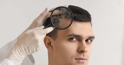 डैंड्रफ के लिए आमतौर पर मेडिकेटेड एंटी-डैंड्रफ शैंपू दिए जाते हैं.