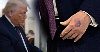 डोनाल्ड ट्रंप के हाथ पर नीला निशान देखने को मिला है.