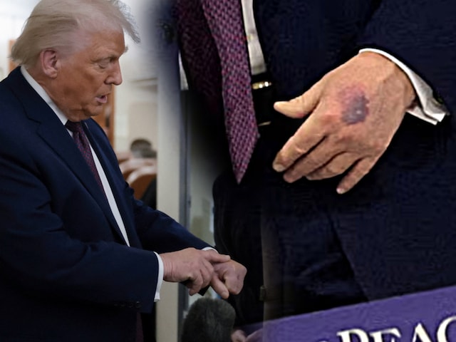 डोनाल्ड ट्रंप के हाथ क्यों पड़ गए नीले? क्या कोई गंभीर बीमारी है, समझें