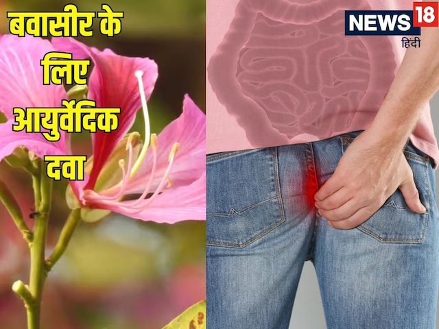 Root of Kaal Kachnar tree for piles, know the right way to use it Root of Kaal Kachnar tree for piles, know the right way to use it