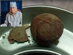 पन्ना के डॉक्टर का कमाल, निकाली आधा किलो वजनी पथरी, युवक को दी राहत