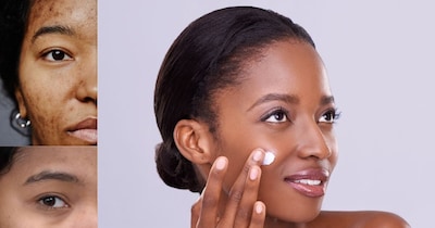 Pimple Dark Spots & Hyperpigmentation: Treatments & Home Remedies Revealed