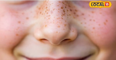 वहीं, नाक पर के छोटे-छोटे कील और दाना होना एक आम समस्या है, लेकिन यह घरेलू उपायों और समाधान से ठीक किया जा सकता है. शहद और नींबू, तेल और हल्दी, और गुलाब जल और चंदन जैसे घरेलू उपाय नाक पर के छोटे-छोटे किल और दाने को ठीक करने में मदद करते हैं.