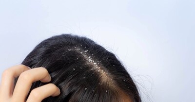 डैंड्रफ की समस्या क्यों नहीं खत्म होती? जानें असली कारण और स्वस्थ स्कैल्प के उपाय.