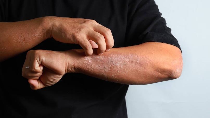 Changes in the skin - If there is any sudden change in the skin, such as change in color of any part or spots, bumps or swelling on the skin, it can be the initial symptom of skin cancer. Image: News18