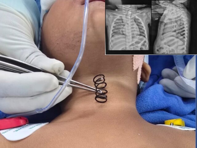 Metal spring stuck in food pipe of 14 month old child, operation done in AIIMS