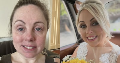 शादी से पहले दुल्हन का चेहरा लटका, Bell's Palsy ने छीनी खुशी, फिर ऐसे हुई ठीक.