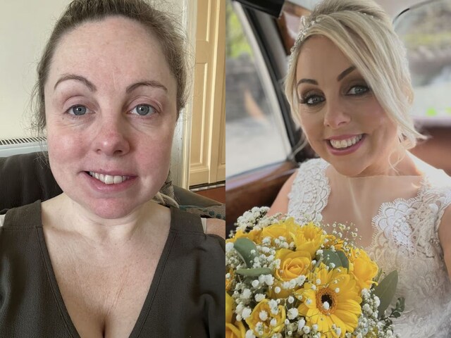 When she woke up, her face was hanging; the bride screamed after seeing herself in the mirror!