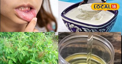 छाले के घरेलू उपाय 