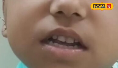 मेंडिकल कॉलेज के डेंटल विभाग ने सफल सर्जरी कर बच्ची की मस्कान ला दी