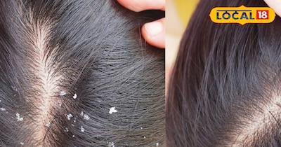 डेंड्रफ 