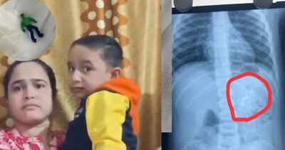 अहमदाबाद: डेढ़ साल के वंश ने हल्क खिलौना निगला, डॉक्टरों ने बचाया.