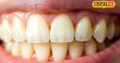 निधि चौधरी ने बताया कि बेकिंग सोडा और नींबू का रस पीले दांतों को ठीक करने के लिए एक प्रभावी घरेलू उपाय है . सबसे पहले, एक बर्तन में एक चम्मच बेकिंग सोडा और एक चम्मच नींबू का रस डालकर उसे अच्छे से मिक्स कर लें. 