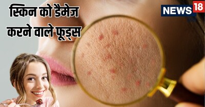 इन 3 फूड्स से बचें: ये त्वचा को एसिड से भी ज़्यादा नुकसान पहुँचाते हैं, स्किनकेयर को करते हैं बर्बाद.