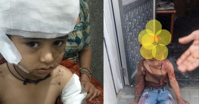 बीकानेर स्कूल में खौफनाक हमला: कुत्तों के झुंड ने बच्चे का आधा सिर नोचा.