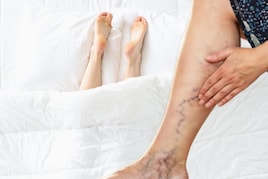 पैरों पर नजर आ रही सूजी उभरी नसें? वैरिकोज वेन्स से छुटकारा पाने का आसान तरीका