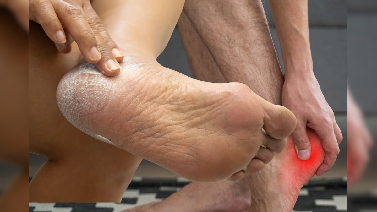 फटी एड़ियों के लिए रामबाण है यह तेल, आयुर्वेदाचार्य ने बताया रात को लगाकर सोने का जादुई फायदा