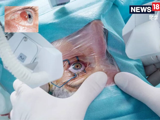 आंख में मटर के दाने जैसा कैंसर लेकर आया विदेशी मरीज, भारतीय डॉक्टरों ने लगा..