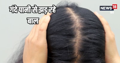 नोएडा के पानी से बाल खराब? हेयरफॉल का जानें सही इलाज, मिल सकती है राहत.