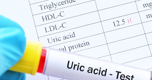 ইউরিক অ্যাসিড কমাতে ৫টি ঘরোয়া উপায় অবলম্বন করুন, শিগগিরই আরাম পাবেন!