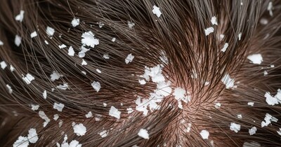 सर्दियों में रूसी से पाएं छुटकारा: अपनाएं ये आसान घरेलू उपाय और रखें स्कैल्प को स्वस्थ.