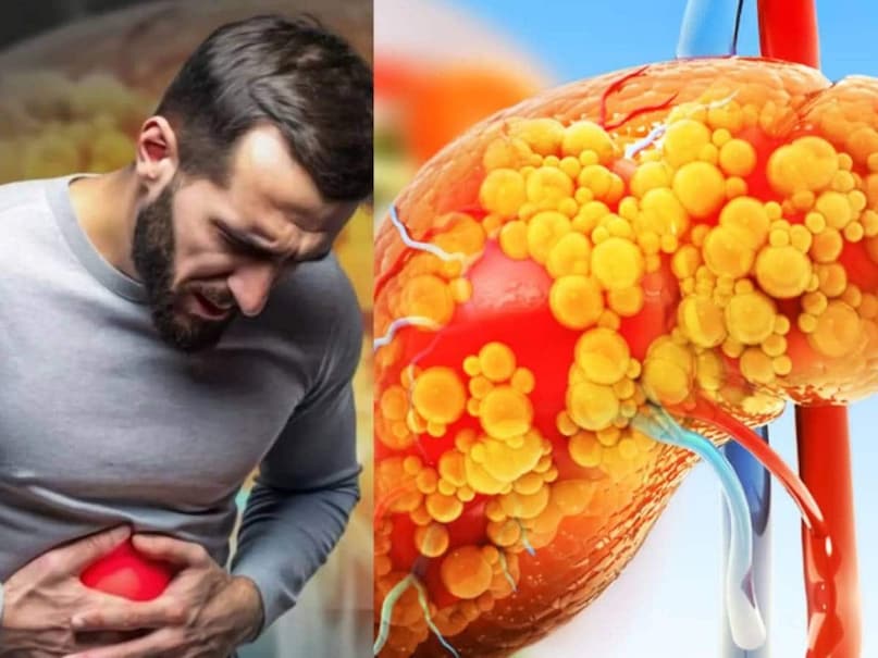 Liver plays an important role in more than 500 functions of the body. The most important feature of this organ is that it does not require detoxification. It is a self-cleansing or self-detoxing organ. However, due to poor dietary habits, fat often accumulates in the liver, which is a worrying condition. This is called fatty liver. If it is not controlled in time, it can be fatal.