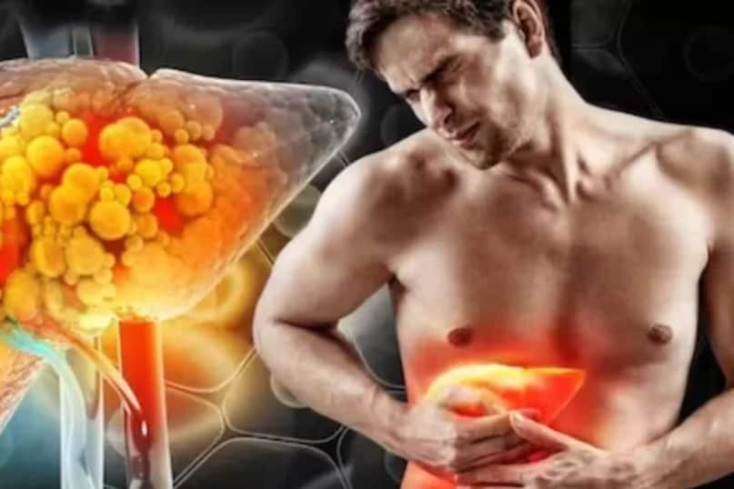 ফ্যাটি লিভারের কিছু প্রাথমিক লক্ষণ পেটে শুরু হয়, কিন্তু মানুষ প্রায়ই এগুলি উপেক্ষা করে কারণ এগুলি সাধারণ পেটের সমস্যা, যেমন গ্যাস, পেট ফাঁপা বা ক্ষুধা হ্রাস হিসাবে দেখা দেয়। বলছেন বিশেষজ্ঞ অনুভব জৈন।