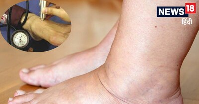 पैरों में सूजन, सुन्‍नपन और दर्द खराब ब्‍लड सर्कुलेशन का लक्षण हो सकता है. 