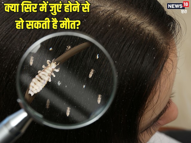 Can lice in hair cause death: Can lice in hair cause death?