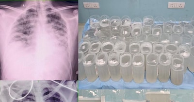 भोपाल एम्‍स के डॉक्‍टर्स ने मरीज की जान बचा दी. 