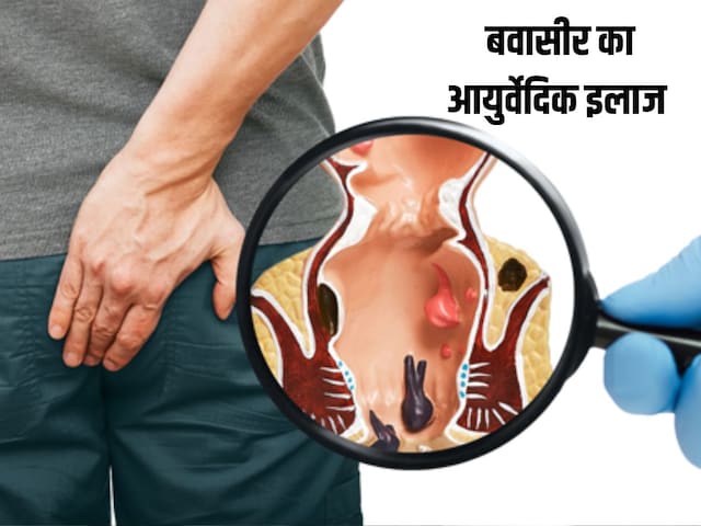 অস্ত্রোপচার ছাড়াই পাইলস নিরাময় করা যায়, এই আয়ুর্বেদিক প্রতিকারগুলি ব্যবহার করে দেখুন 
