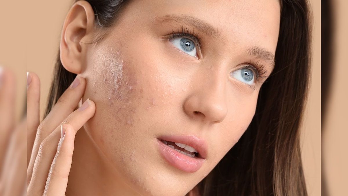 पिंपल्स को जड़ से खत्म कर देगा यह पुराना देसी नुस्खा! बस हल्दी के साथ मिलाएं ये खास पाउडर, चमक उठेगा चेहरा