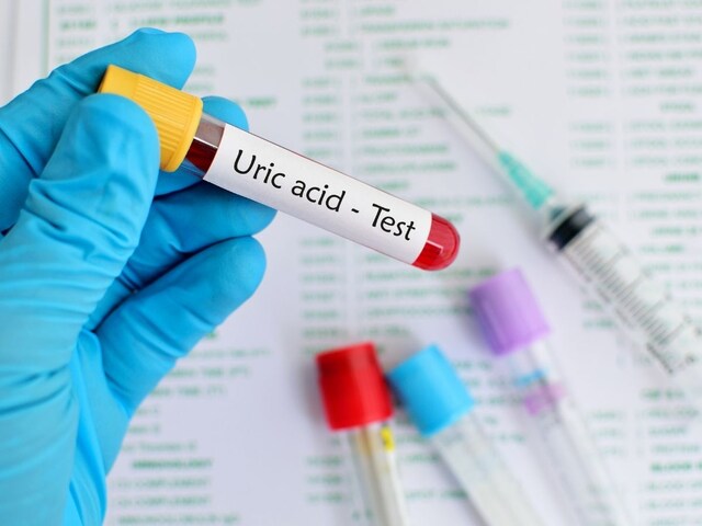 ইউরিক অ্যাসিড সনাক্ত করতে কোন পরীক্ষা করা উচিত? স্বাভাবিক পরিসীমা কি?