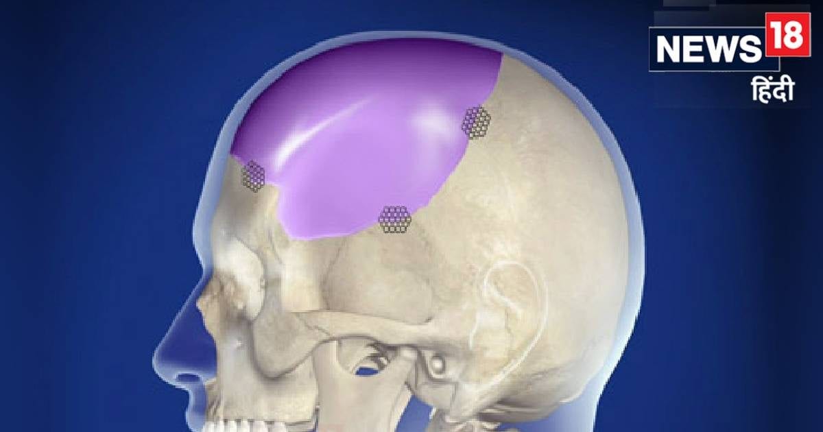 ब्रेन तक फैल गया कैंसर, निकाला खोपड़ी का एक हिस्सा, उज्बेकिस्तान में नहीं मिला इलाज तो आई भारत, यहां मिली जिंदगी