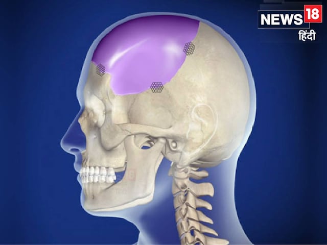 ब्रेन तक फैल गया कैंसर, निकाला खोपड़ी का एक हिस्सा, उज्बेकिस्तान में नहीं...