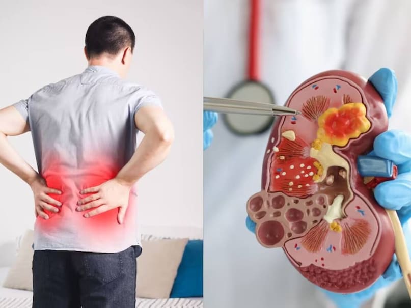 Kidney Cancer, Kidney, Cancer, health, కిడ్నీ, క్యాన్సర్, కిడ్నీ క్యాన్సర్, కిడ్నీ ఫెయిల్, ఆరోగ్యం Kidney Cancer, Kidney, Cancer, health, కిడ్నీ, క్యాన్సర్, కిడ్నీ క్యాన్సర్, కిడ్నీ ఫెయిల్, ఆరోగ్యం