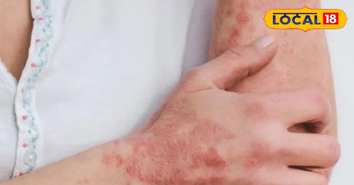 शरीर पर लाल चकत्ते, खुजली का संकेत नहीं, इसे नजरअंदाज करना पड़ सकता है भारी, ऐसे करें इससे