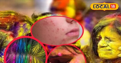 होली के बाद त्वचा-बालों को नुकसान? विशेषज्ञ ने बताए आयुर्वेदिक उपाय.