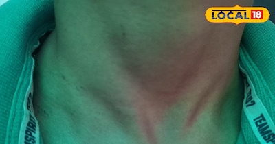 घर बैठे करें शरीर पर लाल डब्बो का इलाज 