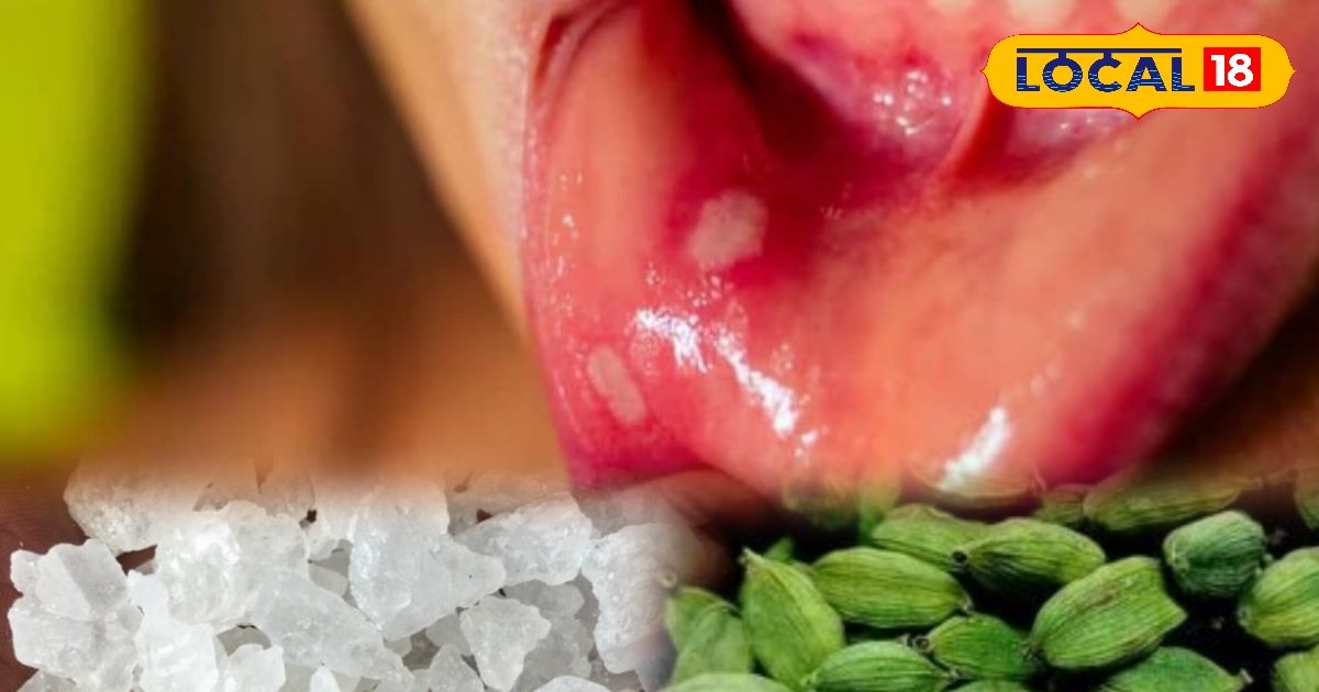 बार-बार हो रहे मुंह के छाले? ये दादी-नानी का नुस्खा दिलाएगा राहत